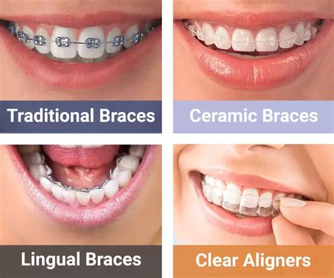 bracket metal orthoclase|Everything You Need to Know About Metal Braces .